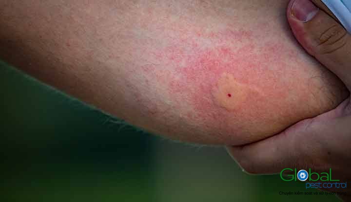 Vết đốt của Muỗi gây ra